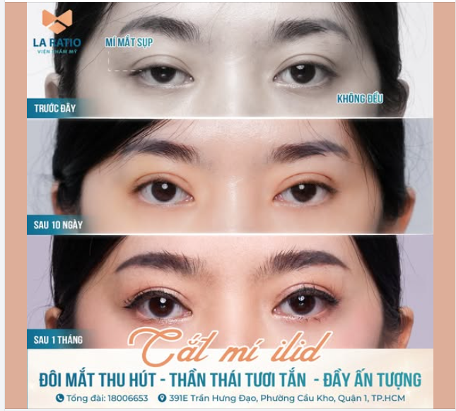 CẮT MẮT 2 MÍ - TẠO MÍ ĐẸP TỰ NHIÊN CHO ĐÔI MẮT