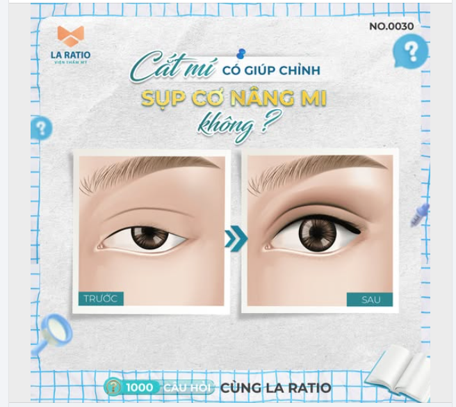 CẮT MÍ CÓ GIÚP CHỈNH SỤP CƠ NÂNG MI KHÔNG