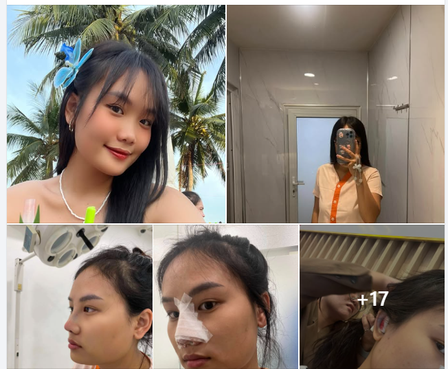 Muốn nói là ai có ý định làm mũi thì làm liền đi mọi người.  Thi ấp ủ 1 năm rồi và mình đã làm mũi được 6 tháng rồi.