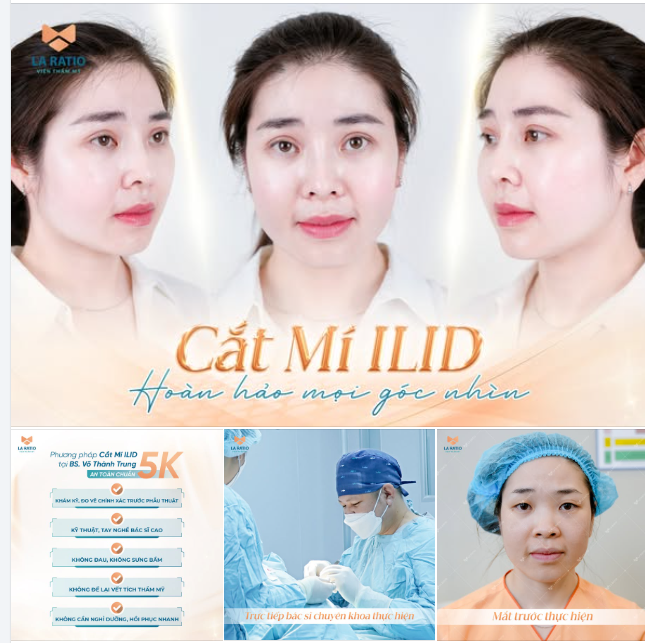 Cắt mí đẹp tự nhiên, xu hướng làm đẹp không lỗi thời