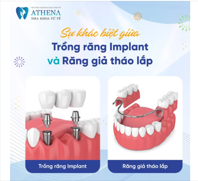 Khi mất răng, việc lựa chọn phương pháp phục hồi luôn là câu hỏi lớn. Trong đó, trồng răng Implant và răng giả tháo lắp là hai giải pháp phổ biến nhất.