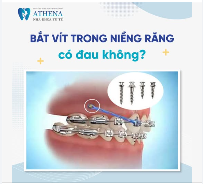 Bắt vít niềng răng (mini vít chỉnh nha) là một kỹ thuật giúp tăng hiệu quả di chuyển răng, rút ngắn thời gian niềng. Vậy bắt vít niềng răng có đau không?