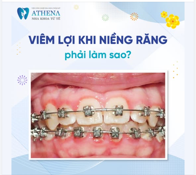 Quá trình niềng răng đòi hỏi sự kiên nhẫn và chăm sóc kỹ lưỡng.