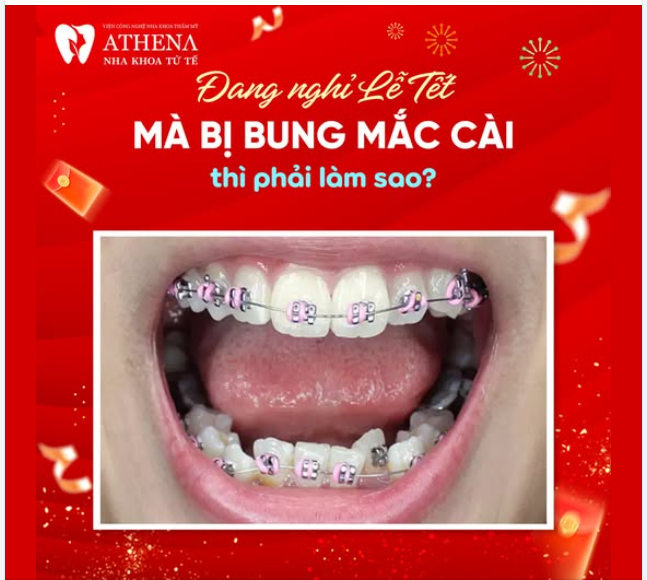 Bung mắc cài là một tình huống không mong muốn khi niềng răng, đặc biệt nếu xảy ra vào kỳ nghỉ lễ Tết khi phòng khám nha khoa tạm nghỉ.