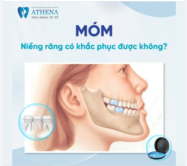 Móm niềng răng có khắc phục được không?