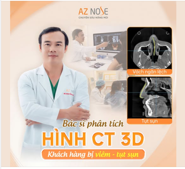 Tái tạo dáng mũi cho khách hàng bị v.iêm - tụt sụn