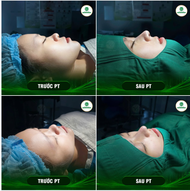 “MỞ BÁT” SÁNG CUỐI TUẦN VỚI MỘT DÁNG MŨI RẤT ĐẸP
