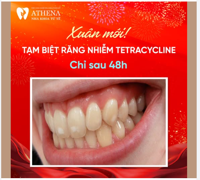 Chào đón một mùa xuân mới, hãy để nụ cười của bạn thêm rạng rỡ với bọc răng sứ tại Nha Khoa ATHENA!
