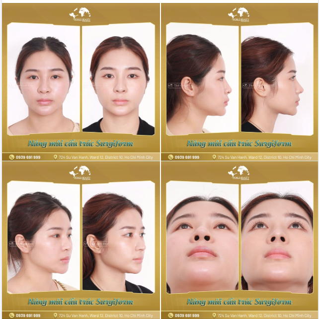 Khiếm khuyết mũi cũ của quý Cô đã qua 1 lần ph.ẫu th.uật với một loạt vấn đề: