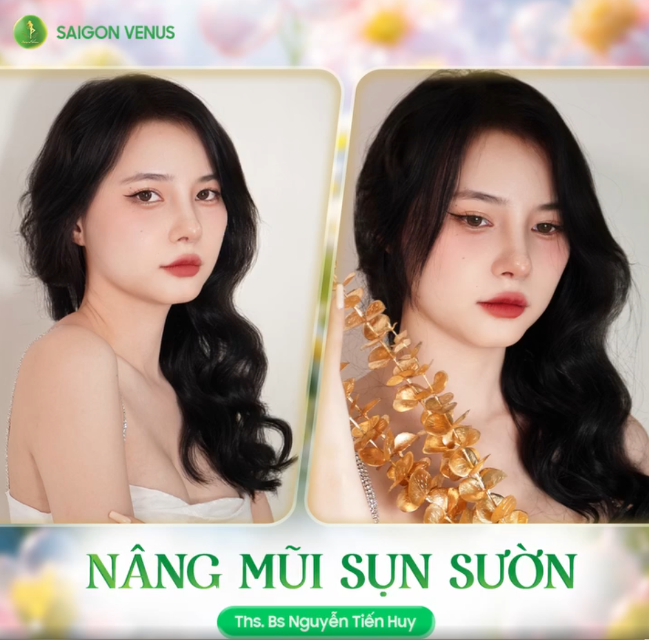 CÔ NÀNG THÙY MIN THAY ĐỔI THẾ NÀO SAU KHI NÂNG MŨI SỬA LẠI TẠI SAIGON VENUS