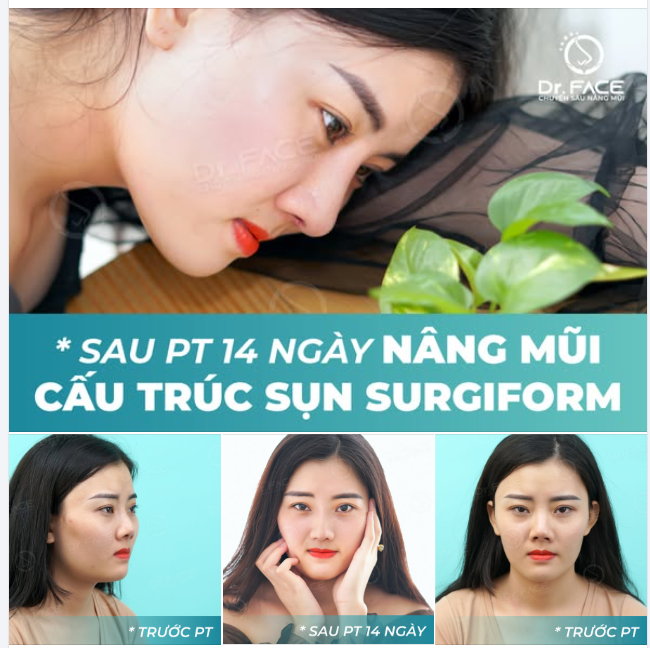 Cô bạn ĐIỀU DƯỠNG KHỔ TÂM vì chiếc mũi CO RÚT