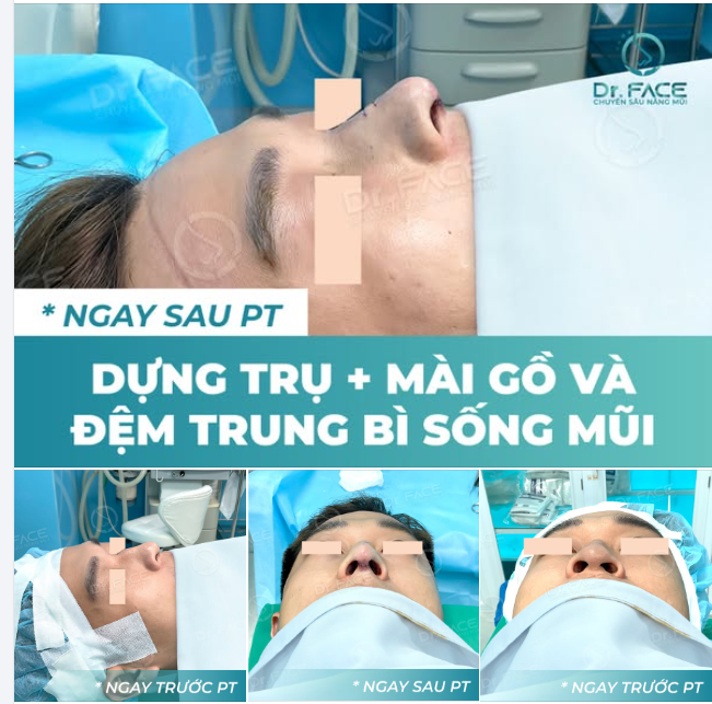 MŨI BỊ GỒ NẶNG, BẠN NAM TƯỞNG PHẢI NÂNG CẤU TRÚC