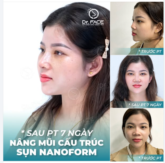 BIẾN DẠNG MŨI VÌ…CẤY CHỈ