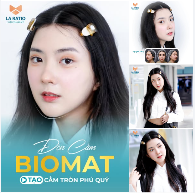 Độn Cằm Biomat – Tạo Cằm Tròn Phú Quý, Tăng Vẻ Đẹp Hoàn Hảo
