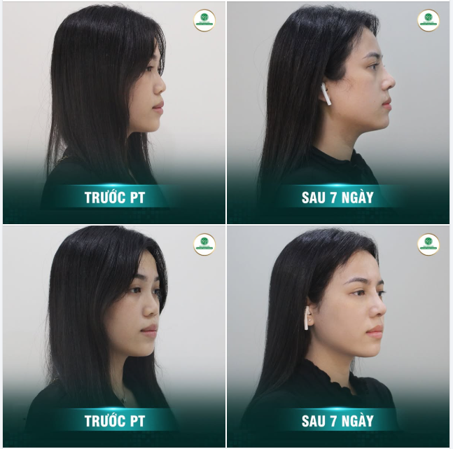 KHÔNG CẦN TRANG ĐIỂM  Nâng mũi thôi cũng giúp cô gái trẻ sở hữu nhan sắc mới ấn tượng và cực kỳ thu hút