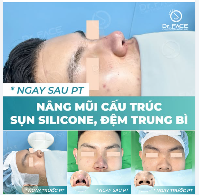 BẠN NAM NÀY CHỌN SỤN SILICONE