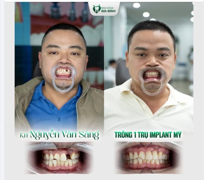 TRỒNG IMPLANT TỨC THÌ - KHÔI PHỤC RĂNG MẤT NHANH CHÓNG