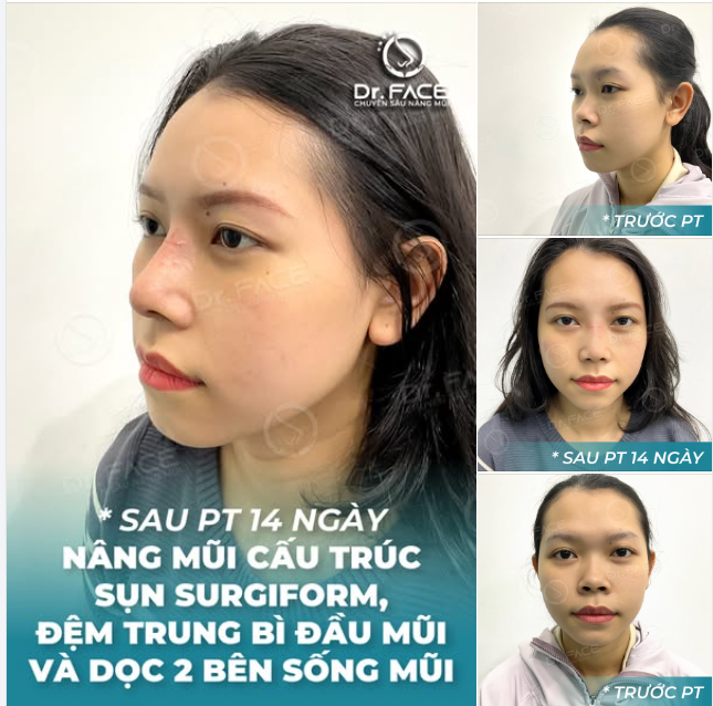 Hành trình tuyệt vời của bạn có thể khởi đầu bằng lựa chọn nâng mũi cấu trúc đệm trung bì (đặt sống bằng sụn Surgiform), giống như bạn gái này chẳng hạn.