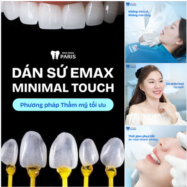 RA MẮT LOẠI HÌNH RĂNG SỨ MỚI – EMAX MINIMAL TOUCH