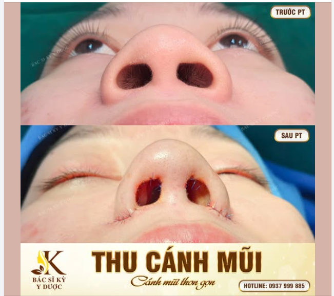 THU GỌN CÁNH MŨI – TẠM BIỆT CÁNH MŨI TO, THÔ