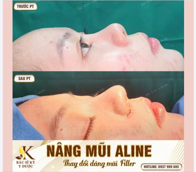 SỬA MŨI TIÊM FILLE – ĐỊNH HÌNH DÁNG MŨI HOÀN HẢO