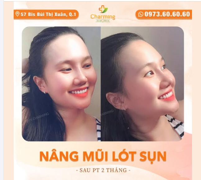 Sau khi thực hiện nâng mũi lót sụn, nàng khách sở hữu dáng mũi cao thanh thoát, giúp tổng thể khuôn mặt trông hài hòa và cuốn hút hơn.