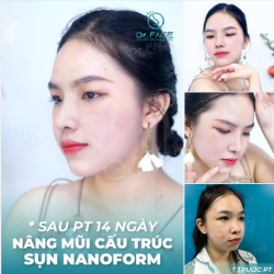 Xem cô bạn nâng mũi CẤU TRÚC SỤN TAI (đặt sống bằng sụn Nanoform) của tôi kìa.