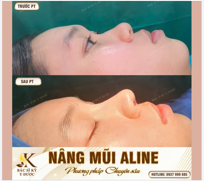 NÂNG MŨI ALINE - TẠO DÁNG MŨI HOÀN HẢO