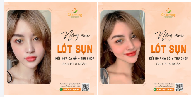 Sau khi thực hiện nâng mũi lót sụn, thu chóp, cà gồ tại Charming, nàng khách đã có một dáng mũi hoàn hảo, giúp khuôn mặt trở nên hài hòa và cuốn hút hơn.