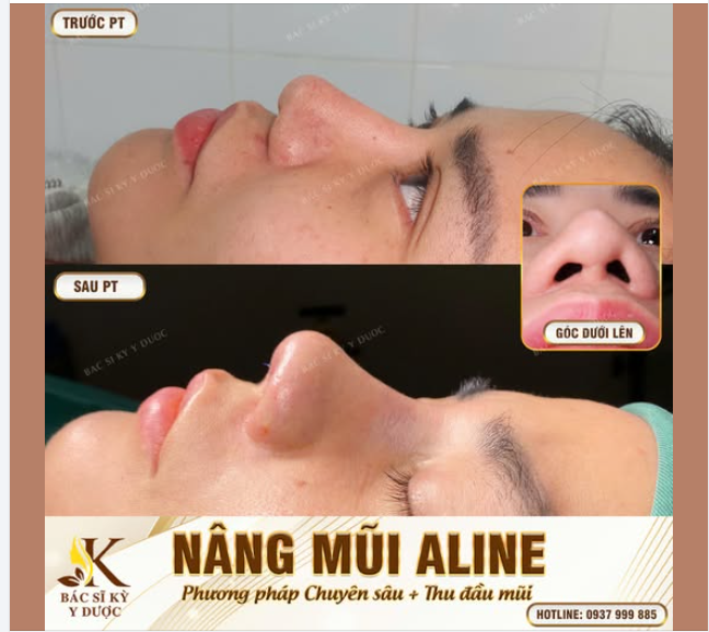 GIẢI CỨU CHIẾC MŨI – XÓA TAN KHUYẾT ĐIỂM!