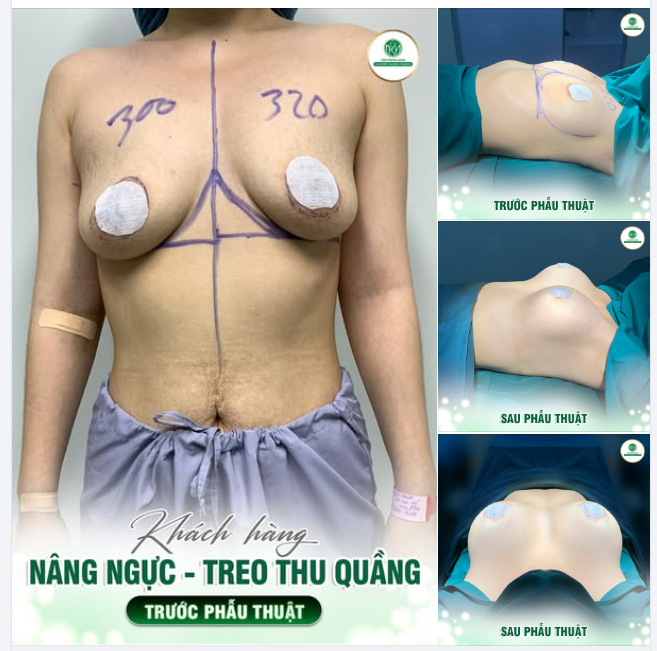 VÒNG 1 CHẢY XỆ, MẤT CÂN ĐỐI KHIẾN BẠN THIẾU TỰ TIN?