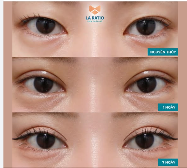 HÀNH TRÌNH VÀO FORM SAU 7 NGÀY CẮT MÍ ILID SẼ NHƯ THẾ NÀO?