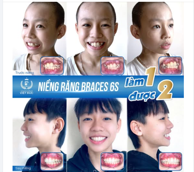 LÝ DO NÊN NIỀNG RĂNG SỚM CHO CÁC BÉ