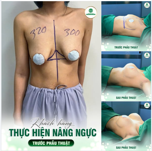 TUỔI CÒN TRẺ NHƯNG NGỰC ĐÃ CHẢY XỆ