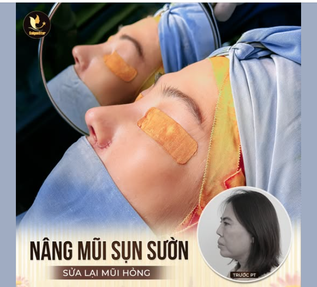LÀM MỚI DIỆN MẠO - KHẮC PHỤC MŨI HỎNG CHỈ TRONG TÍCH TẮC