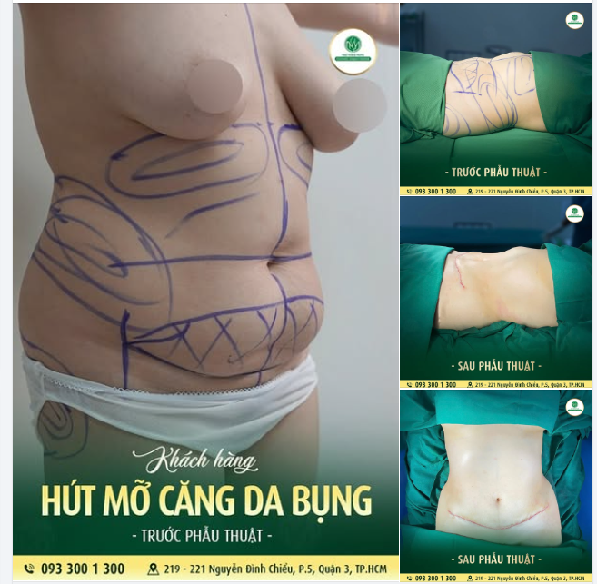 BIẾN HÌNH XINH ĐẸP CHỈ SAU 1 LIỆU TRÌNH HÚT MỠ CĂNG DA BỤNG
