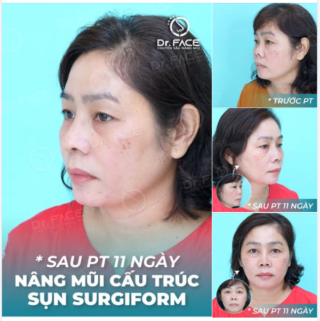 10 NĂM TÌM KIẾM BS SỬA LẠI MŨI CO RÚT