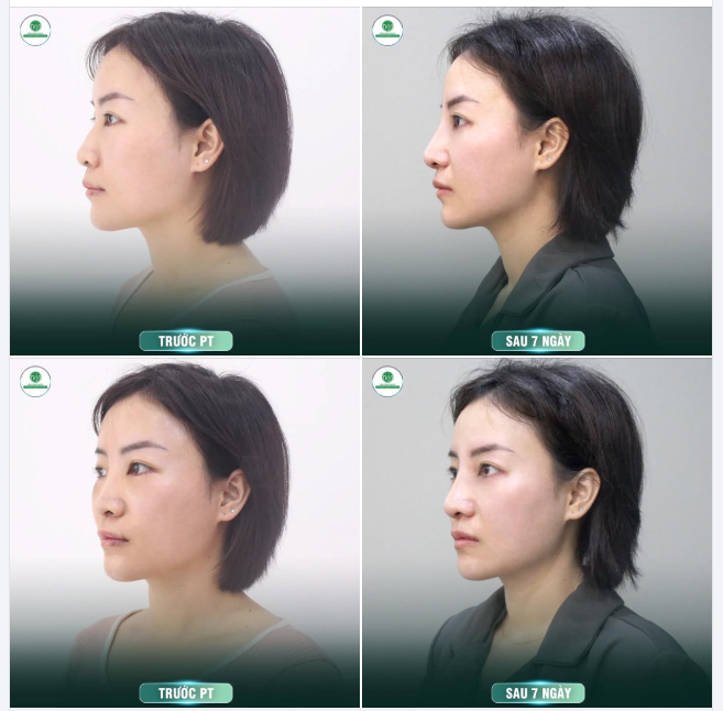KẾT THÚC 1 NGÀY BẬN RỘN VỚI DÁNG MŨI SAU 7 NGÀY