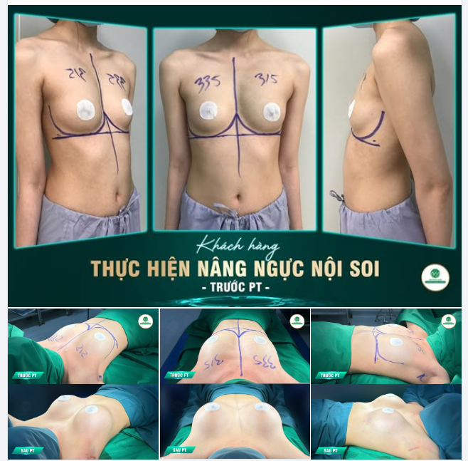 LÀM ĐẸP VÒNG 1 CHO KH THÍCH DÁNG NGỰC TỰ NHIÊN