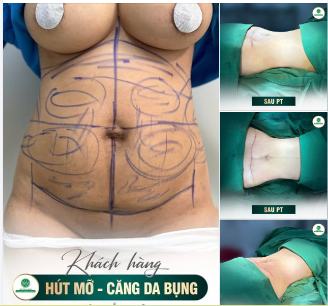 NHỚ CHUẨN BỊ TỦ ĐỒ MỚI TRƯỚC KHI ĐẾN BV GIẢM MỠ NHÉ!