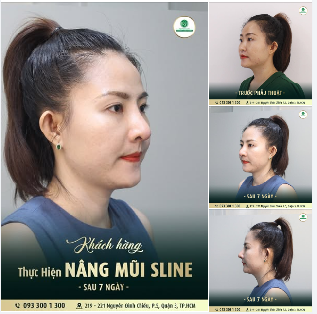 TÁI KHÁM SAU 7 NGÀY VỚI DÁNG MŨI S-LINE HOÀN HẢO!