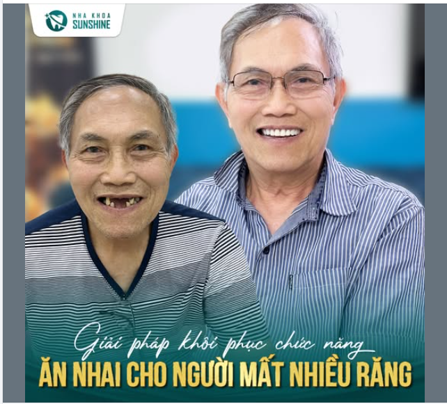 Mất răng không chỉ ảnh hưởng đến thẩm mỹ mà còn gây TIÊU XƯƠNG, làm SUY YẾU cấu trúc hàm!