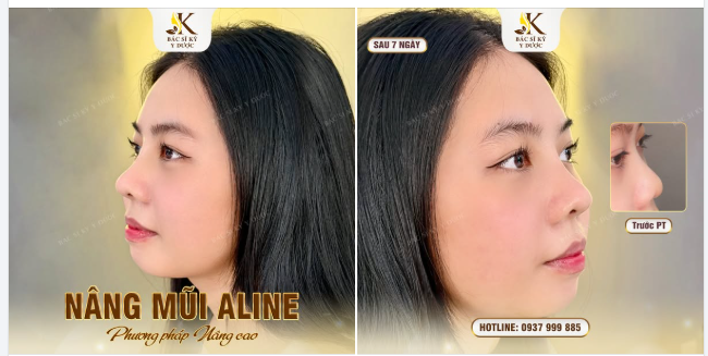 NÂNG MŨI ALINE – NÂNG CAO VẺ ĐẸP CỦA BẠN