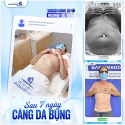 HÀNH TRÌNH LỘT XÁC CỦA MR. DAVID BAY TỪ ÚC ĐẾN VIỆT NAM ĐỂ CĂNG DA BỤNG