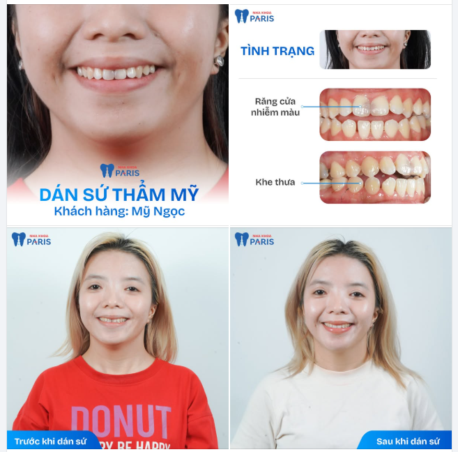 RĂNG ĐỀU SÁNG ĐẸP - NÉT CƯỜI THÊM DUYÊN!