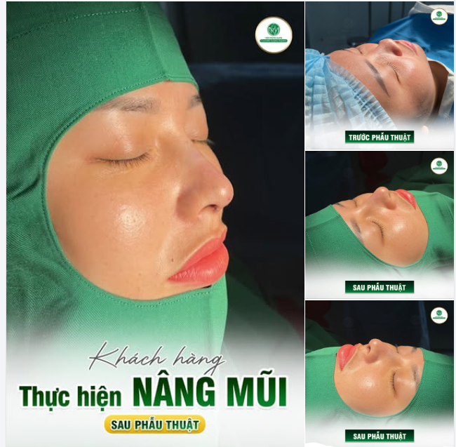 CẬN CẢNH DÁNG MŨI CỰC XINH NGAY SAU THỰC HIỆN