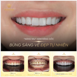 “NÂNG NIU” HÀM RĂNG GỐC - BỪNG SÁNG VẺ ĐẸP TỰ NHIÊN