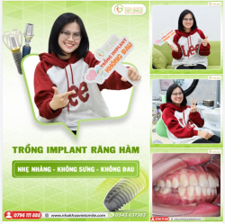 TRỒNG IMPLANT NHẸ NHÀNG, KHÔNG SƯNG, KHÔNG ĐAU - KHẮC PHỤC RĂNG HÀM MẤT