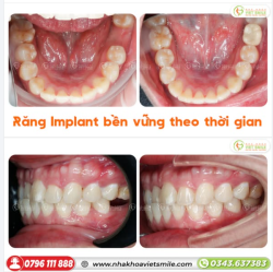 Thêm một ca cấy ghép Implant thành công tại Viet Smile!