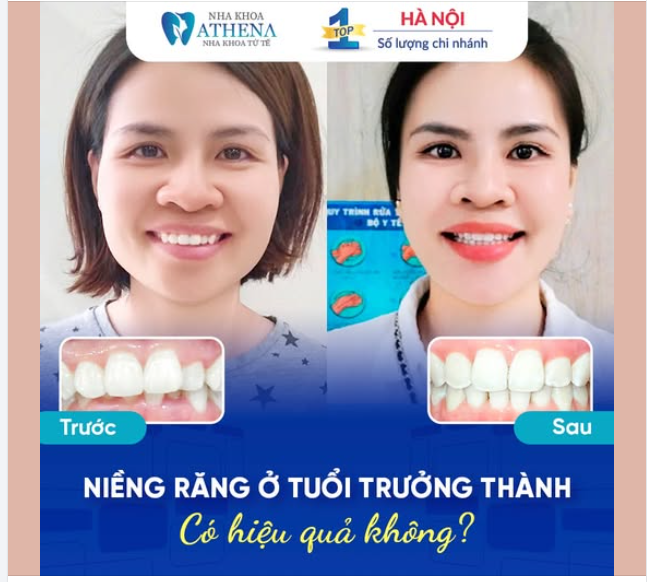 NIỀNG RĂNG Ở TUỔI TRƯỞNG THÀNH – CÓ HIỆU QUẢ KHÔNG?